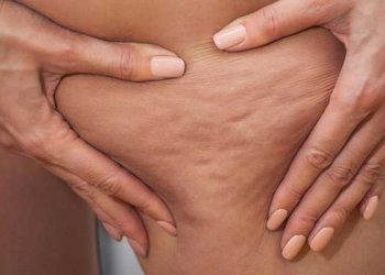 Selülit Nedir? Selülit Nasıl Geçer?
